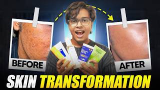 How I Fixed My Skin in 2 months 😳 (Real Transformation) | Combination Skincare Routine |PistarDreams