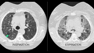 Air trapping on the chest x ray and CT scan