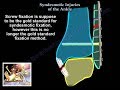 Syndesmotic Injuries Of The Ankle - Everything You Need To Know - Dr. Nabil Ebraheim