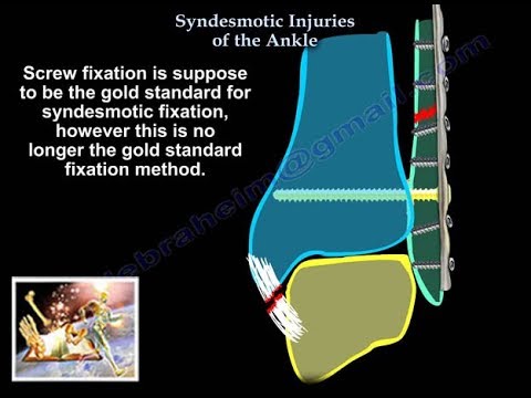 Syndesmotic Injuries Of The Ankle - Everything You Need To Know - Dr. Nabil Ebraheim