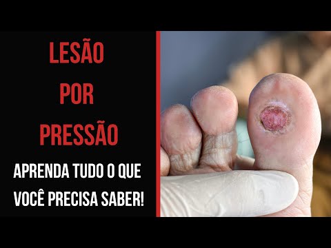 LESÃO POR PRESSÃO: APRENDA TUDO O QUE VOCÊ PRECISA SABER