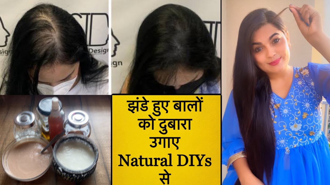 How to fix Receding Hairline Naturally Regrowth* 100 Get longer