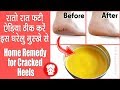 रातों रात फटी एड़ियां ठीक करें इस उपाय से | 100% Effective Home Remedy for Cracked Heels & Dry Skin