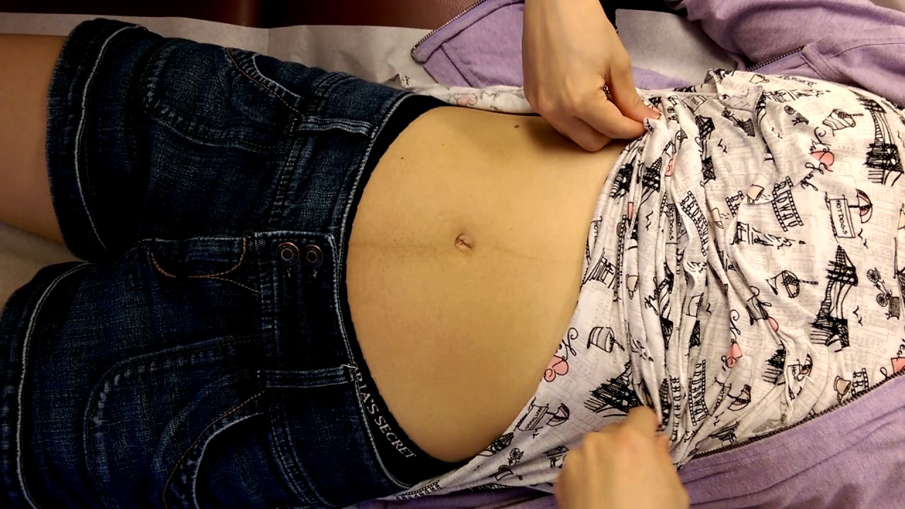 張孟超醫師－腹診- 懷孕並存子宮肌瘤及卵巢囊腫(4)自然產後第十周