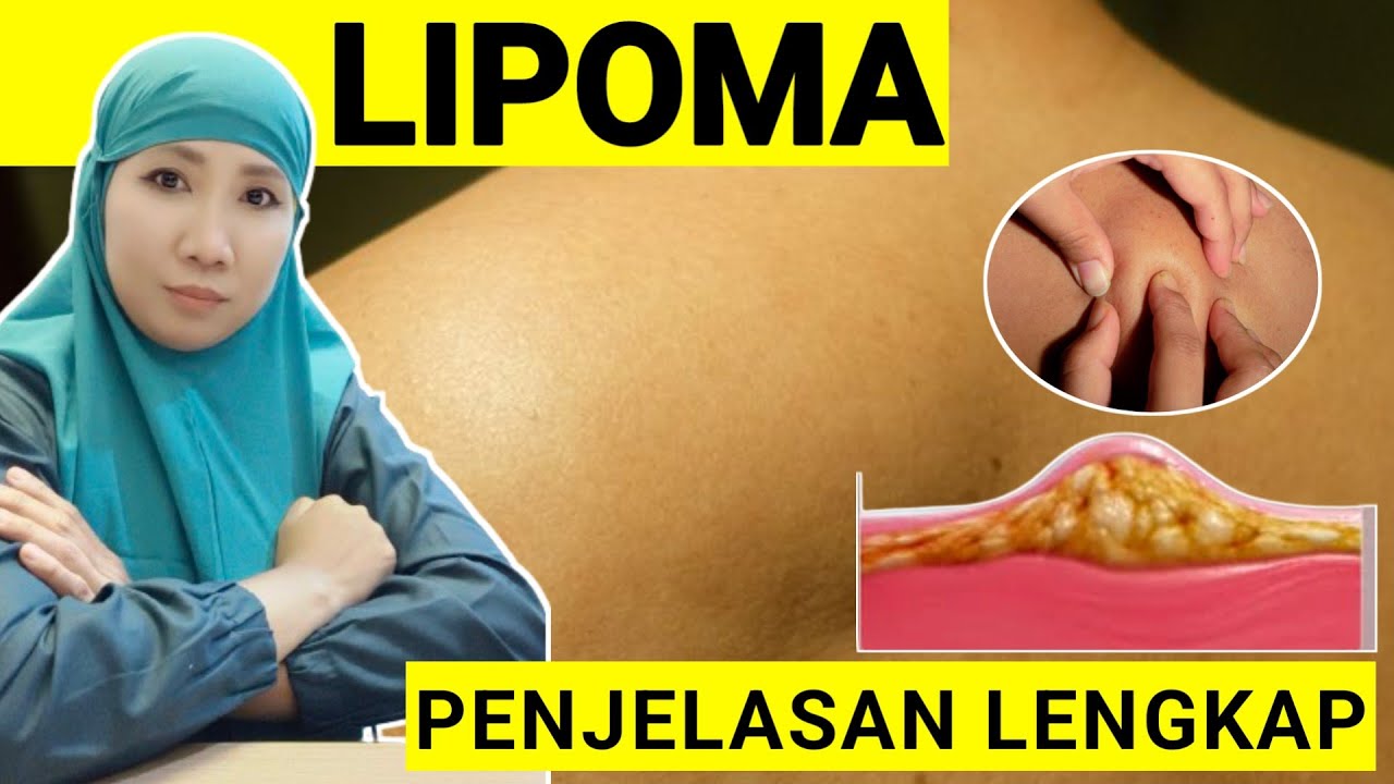Вопросы о липомах || Являются ли липомы раковыми?