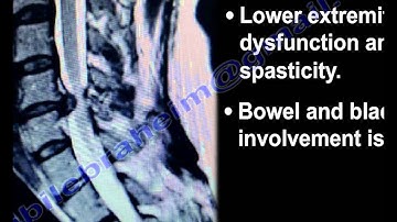 Cervical Spine Myelopathy - Everything You Need To Know - Dr. Nabil Ebraheim