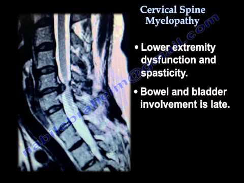 Cervical Spine Myelopathy - Everything You Need To Know - Dr. Nabil Ebraheim