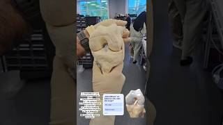 InternalBrace en LCA: Botón Femoral + Tornillo Tibial, Fijación Independiente que Reduce Re-rupturas