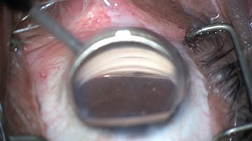 iTrack™ Procedural Steps: Viscodilation