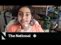 Canada's youngest total artificial heart transplant patient