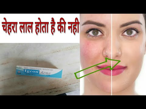 Igcon -Acne Cream | क्या इस से चेहरा लाल होता है | इस Cream को लगाने का सही तरीका | Review Hindi