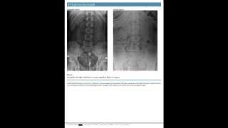 Presenting The SpineTech PRO Chiropractic Report of Findings Page by Page