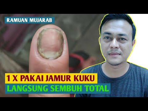 Video: Minyak Pohon Teh Untuk Jamur Kuku: Cara-Cara, Kerjanya, Dan Aman