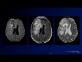 Neuroradiology Board Review - Brain Tumors - Case 1