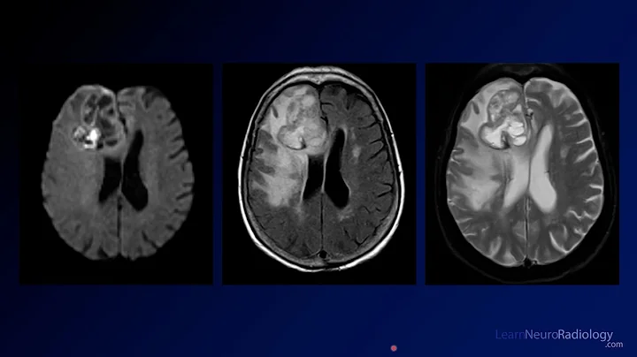 Neuroradiology Board Review - Brain Tumors - Case 1