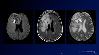 Neuroradiology Board Review  Brain Tumors  Case 1