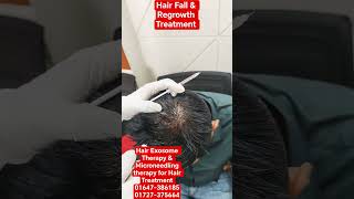 Exosome Therapy For Hair Fall &amp; Hair Regrowth Treatment.