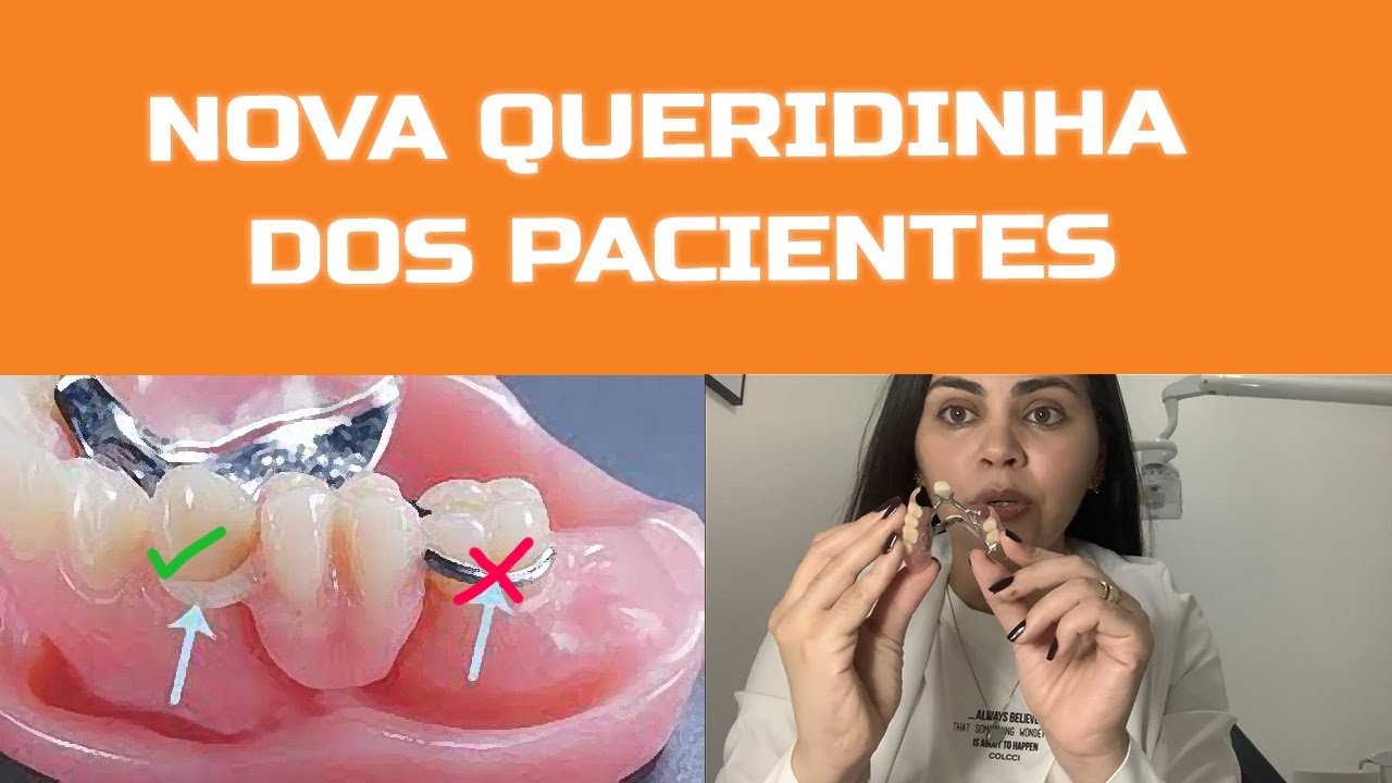 Conheça a Nova Prótese Dental Queridinha dos Pacientes