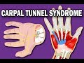 Carpal Tunnel Syndrome Quiz