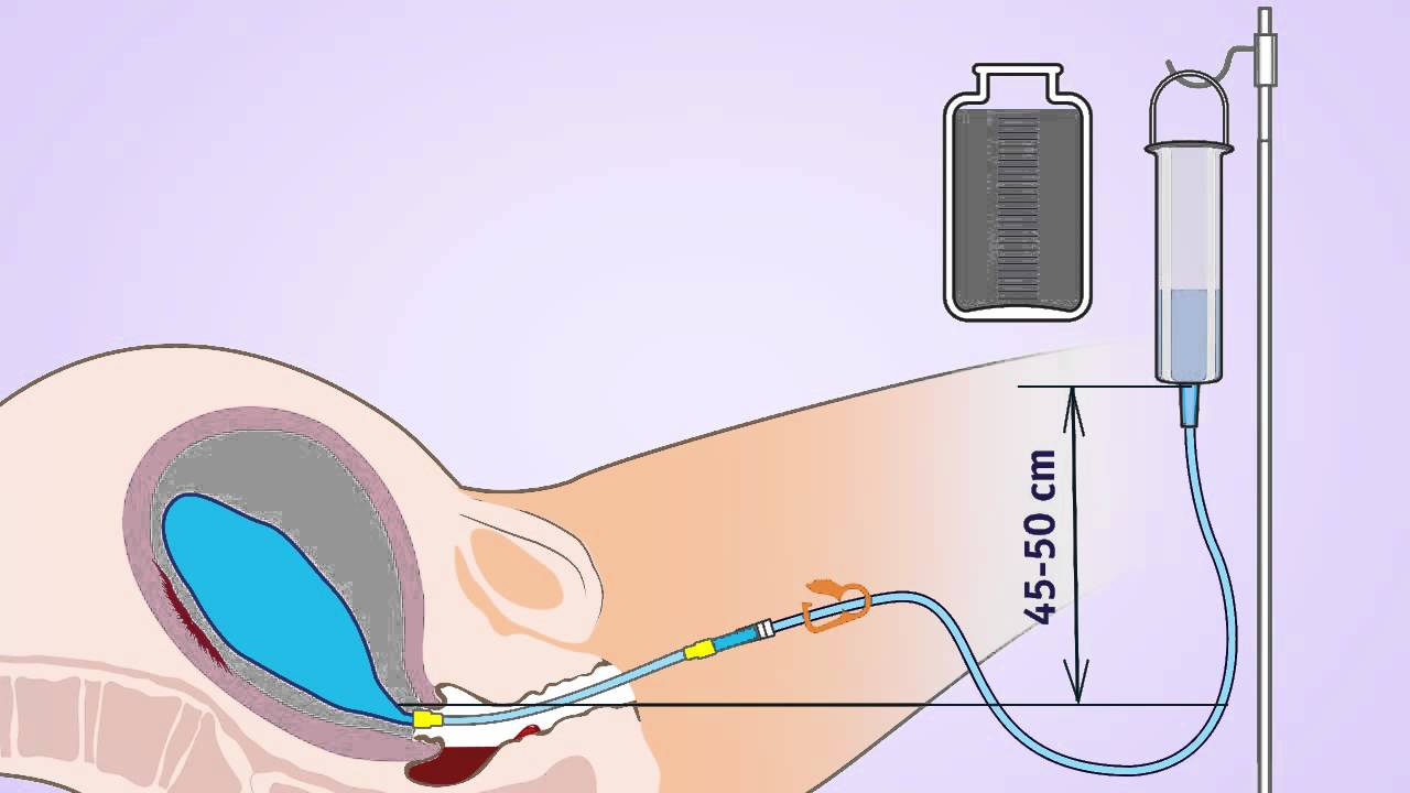 Fecal Incontinence Expanded