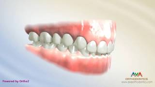 Orthodontic Treatment for Deepbite - Cantilever Wire