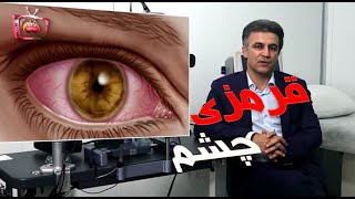 دلایل قرمزی چشم - دکتر پوررضا