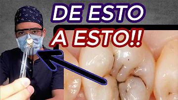 ¿Cómo saber si su caries es profunda?