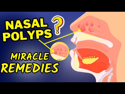 Best Natural Remedies For Nasal Polyps | How To Treat Nasal Polyps At Home Naturally