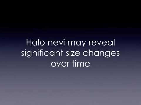 Video: Halo Nevus Sau Mole: Simptome, Cauze, Diagnostic și Tratament