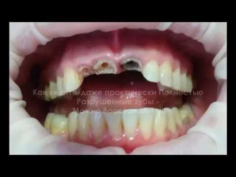 Dr-Azamat Tekuyev-Smile Designer-vkladki kultevie-koronki keramicheskie03