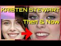 Kristen Stewart then and now 🤓 Before &amp; After the Surgery!! all about her teeth transformation