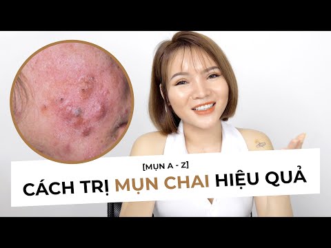 CÁCH XỬ LÝ MỤN CHAI HIỆU QUẢ, AN TOÀN - Chuyện dùng Benzoyl Peroxide, BHA chứa cồn bị chai mụn :(