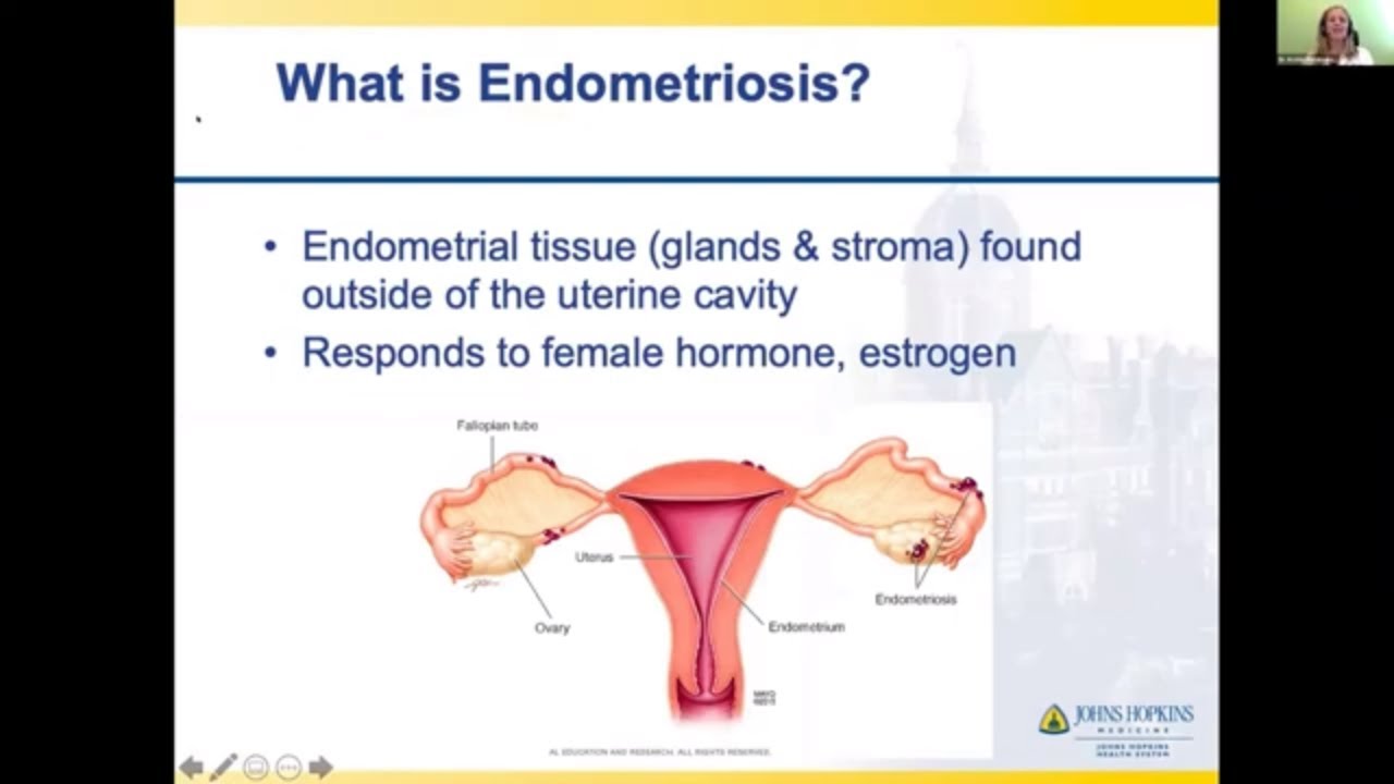 Normal Menstrual Cramps or Endometriosis: How to Tell the Difference:  OB-GYN Associates of Marietta: Obstetrics and Gynecologist