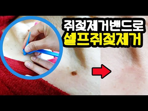 쥐젖제거방법 비립종 연성섬유종 집에서 셀프로 간단히 쥐젖제거하기  목쥐젖 피부꼬리 고민이신분 참고하세요