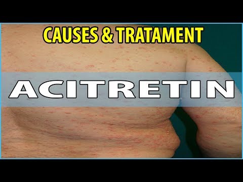 What is  Acitretin, Causes, Symptoms and Treatments