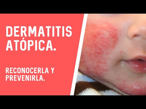 Vídeo: Com Tractar La Dermatitis Atòpica En Un Nen