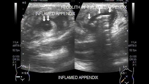 Inflamed appendix with fecalith in its interior.