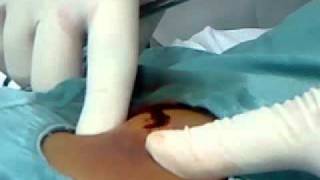 Coágulo sangue joelho de tratar o como atrás do