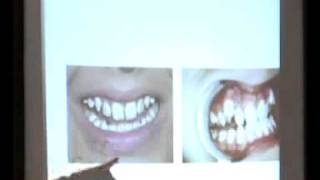Dr. James Beck Fluoride Discussion