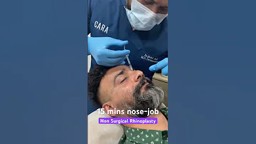 Non surgical rhinoplasty | Instant nose job results in just 15 mins