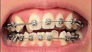 Adult Braces Time Lapse - 8 Month Progression - Front View - Premolar Extraction - Moving Canine