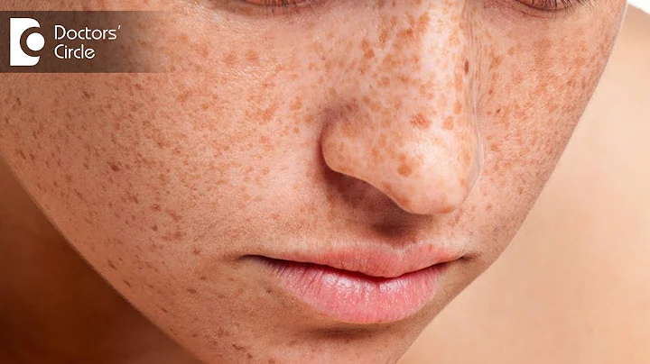 How to get rid of freckles on face? - Dr. Swetha Sunny Paul - DayDayNews