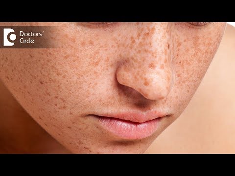 वीडियो: Freckles का इलाज कैसे करें