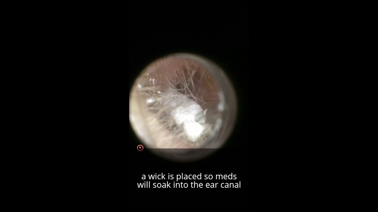 Otitis Externa With Wick Placement Severe Canal Narrowing