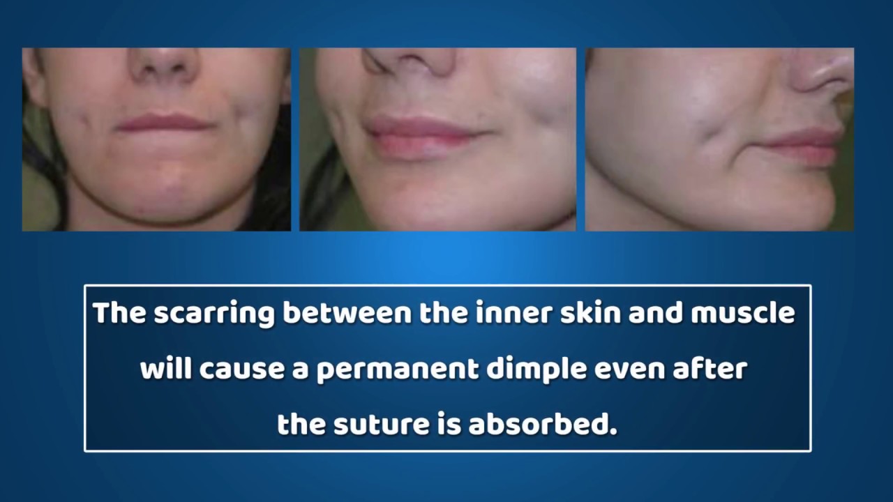 How To Get A Natural Dimple Advance Dimple Creation Surgery Procedure