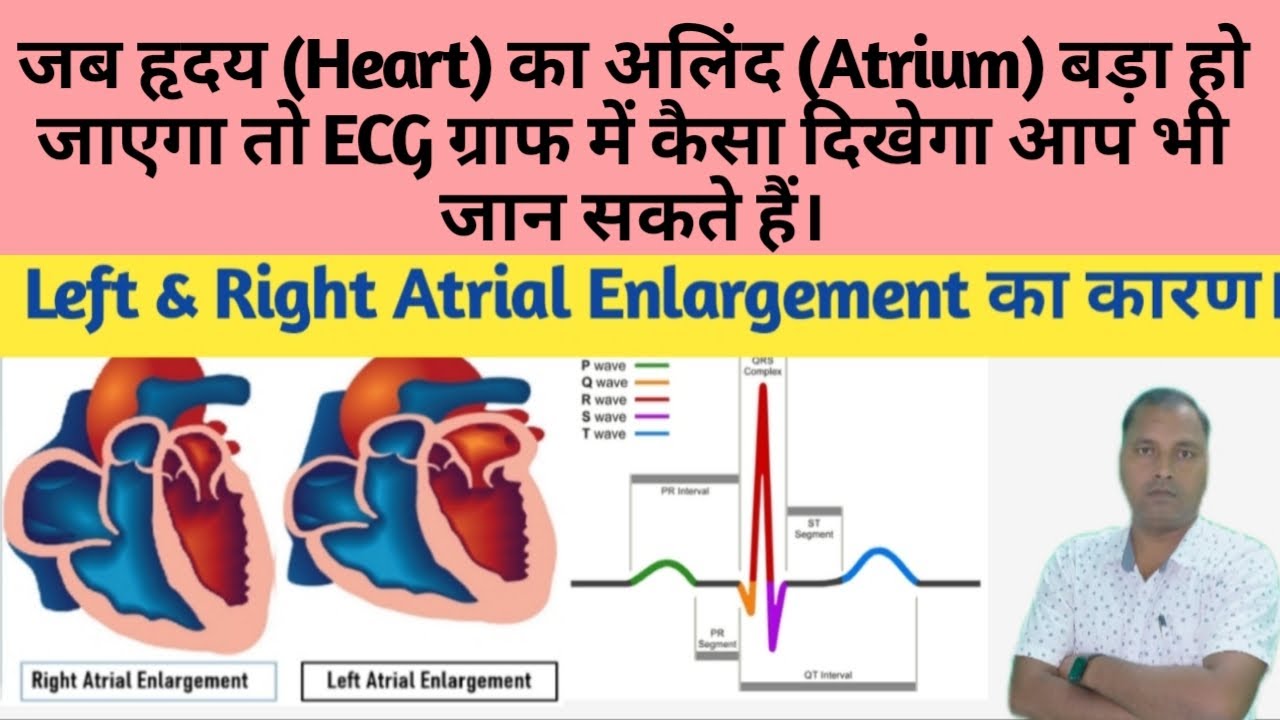 Atrial Enlargement In Hindi Right Atrial Enlargement Left Atrial Atrial enlargement in hindi right atrial enlargement left atrial