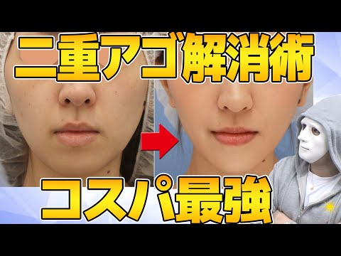 【脂肪吸引じゃない】顔のあご下のたるみをすっきりする方法【湘南美容の医師が原因も含めて解説】