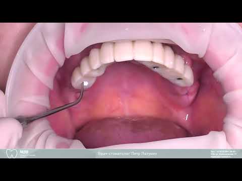 Фиксация временных коронок