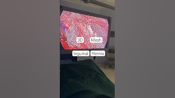 3D Mesh | 3D NET I Hernia Net I Hernia Mesh I Laparoscopic Inguinal Hernioplasty