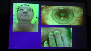 Послеоперационное ведение пациентов с катарактой и глаукомой